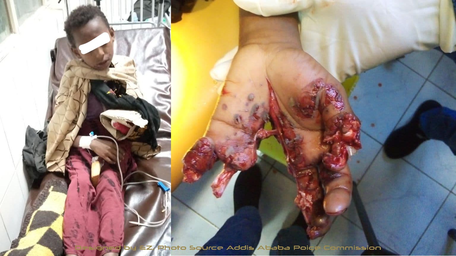 በቦምብ ፍንዳታው እጁ ላይ ከባድ ጉዳት የደረሰበት የ13 ሕፃን